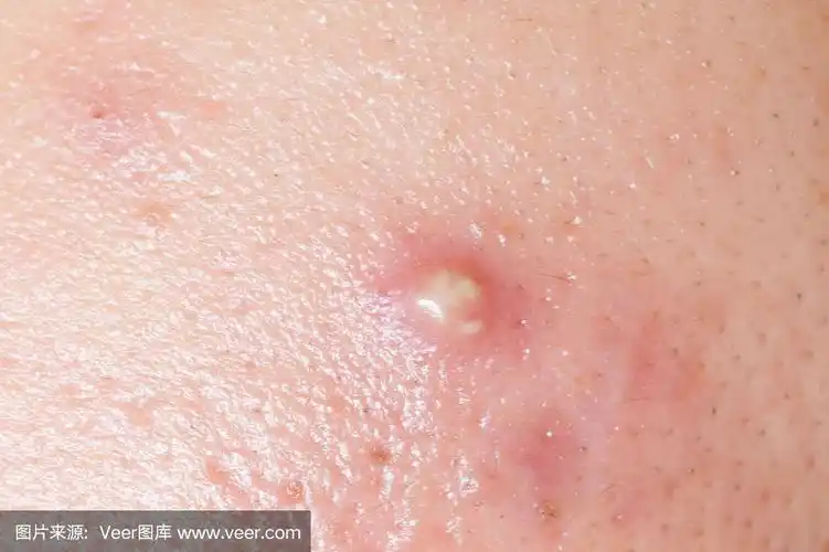 青春痘或痤疮脓肿特写