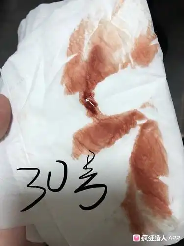 孕早期出血 有图慎入