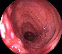 糜烂性胃炎的明显特征