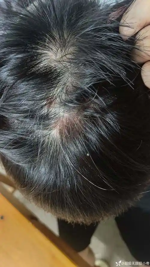 求助:头皮发红,瘙痒伴脱屑