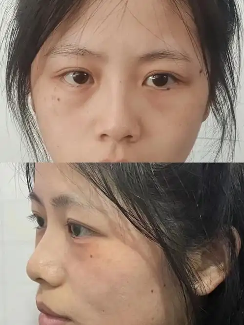 泪沟填充后来咋样了