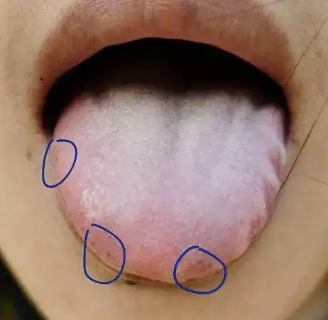 病因病机就是中医说的气滞血瘀然后昨天我讲了一个我的患者,她除了