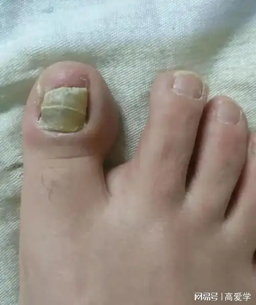 去灰指甲自用抑菌液分享!不愧是国货之光!30天黄厚灰甲自己掉!