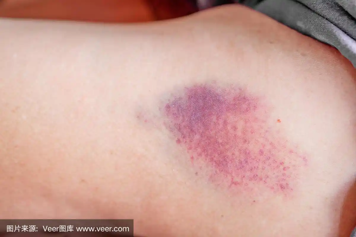 这是女人手臂上的大注射淤青