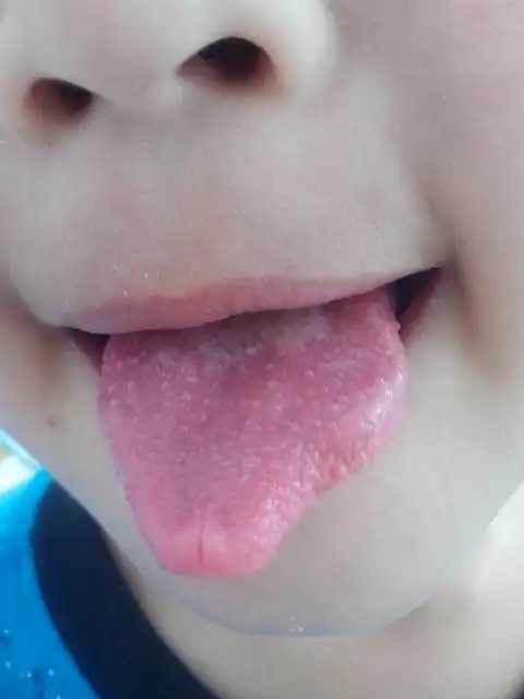 孩子嗓子红肿,现在舌头上有小点,现在已经不发烧了