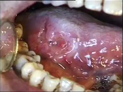 牙龈癌早期症状图片(55)
