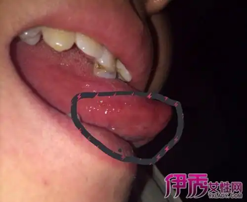 【图】鉴析艾滋病舌头红点图片 警惕艾滋病病毒症状