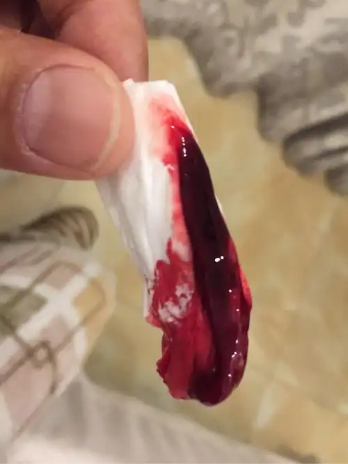 求助帖鼻子流血