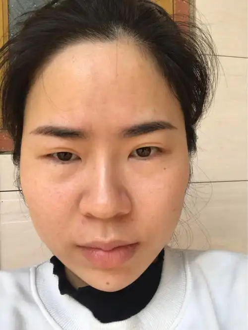 我的埋线双眼皮崩线了,过几天去做双眼皮