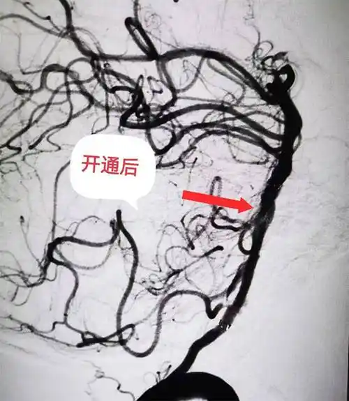 中年男子一觉醒来突发脑干梗死 多学科救治顺利脱险_患者_张静波_循环