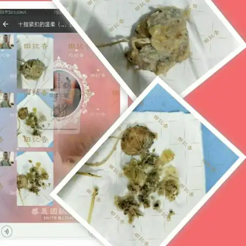 17取豆渣霉菌,糜烂,排出物发绿色,阴道炎症厉害,有输卵管垃圾,绳子