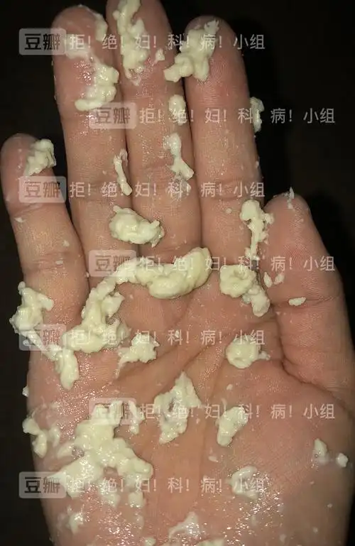 2年多的霉菌史,经验分享,带图慎入