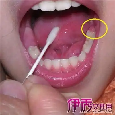 【图】小舌头发炎图片大全 其治愈方法大盘点