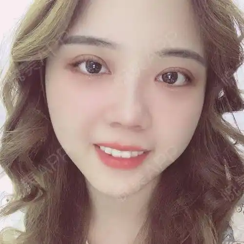 全切双眼皮术后30天_双眼皮术后30天_眼部整形术后30天_悦mer_003241