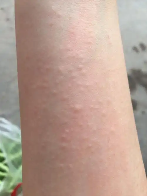 皮肤痒一挠就起这种小疙瘩是怎么回事------求解啊