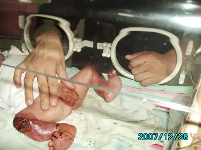 先天性皮肤缺损合并双拇趾发育不良1例 - 好大夫在线