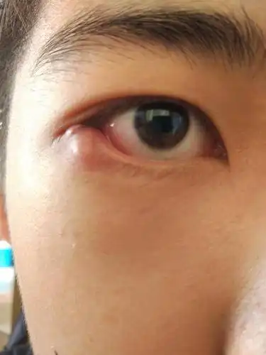 眼睛的眼角长了一个大痘痘