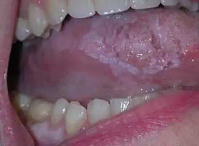 口腔癌的早期症状图(51)