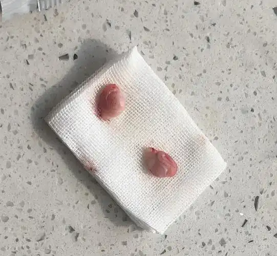 讨论巨蛋少年终于割蛋变公公因为蛋真的很大所以分享