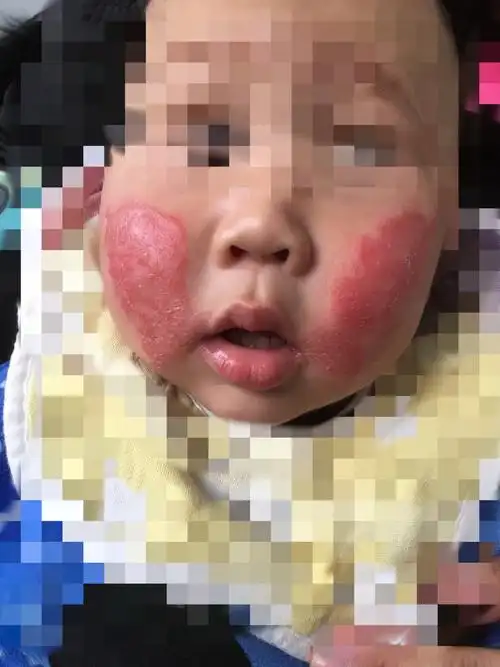 图2湿疹2.jpg