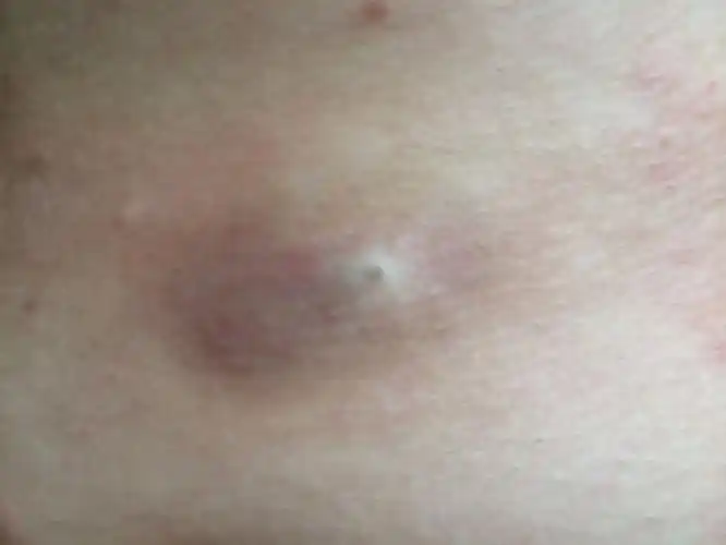 耳朵后边的皮脂腺囊肿图片