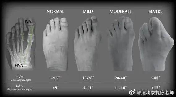 今天就从以下几个方面为大家科普一下95999599  【踇外翻危害