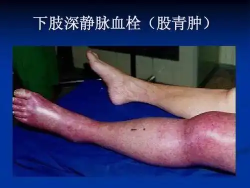 静脉血栓最初表现为下肢(主要是小腿)肿胀,胀痛,沉重感,并有站立,行走