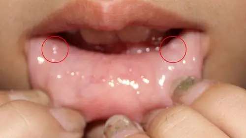 有半月的时间了,女儿下嘴唇里长出两个大
