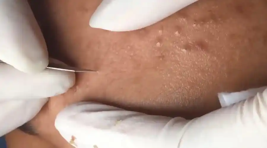 勤奋的蚊蚊         挤黑头,挤 痘痘,挤粉刺,挤白头,第2056部 勤奋