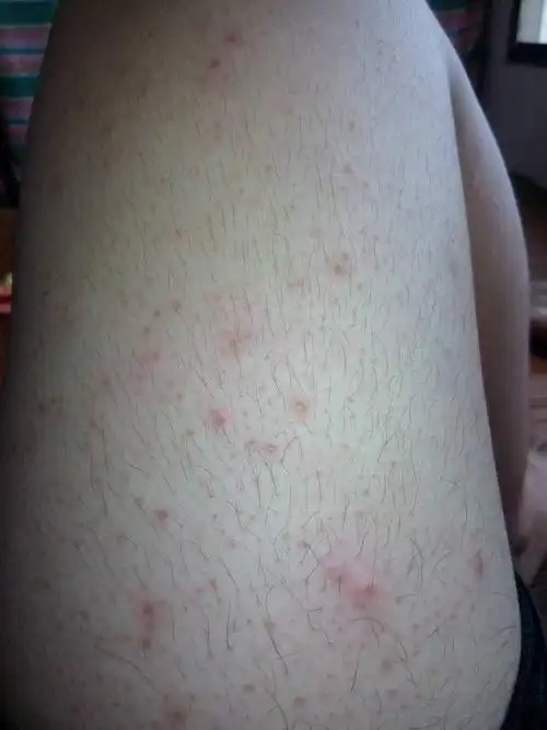 546364lv19 擅长:暂未定制 向ta提问私信ta  展开全部 考虑毛囊炎