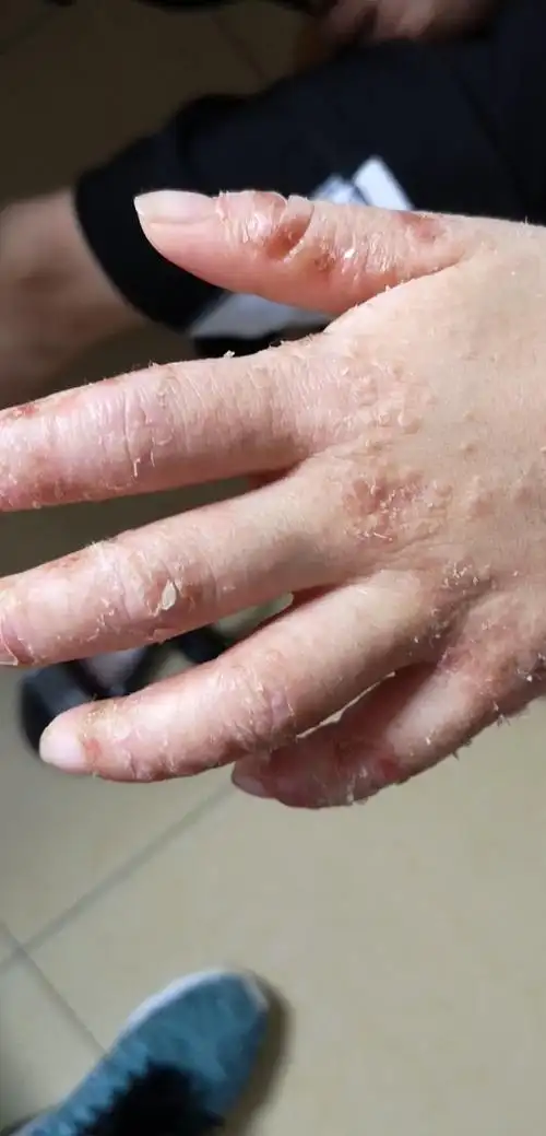 什么是湿疹_湿疹_湿疹介绍 - 好大夫在线