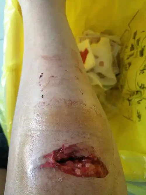 因公交站牌座椅刮伤,很严重,肌肉撕裂,伤口见骨怎么起诉