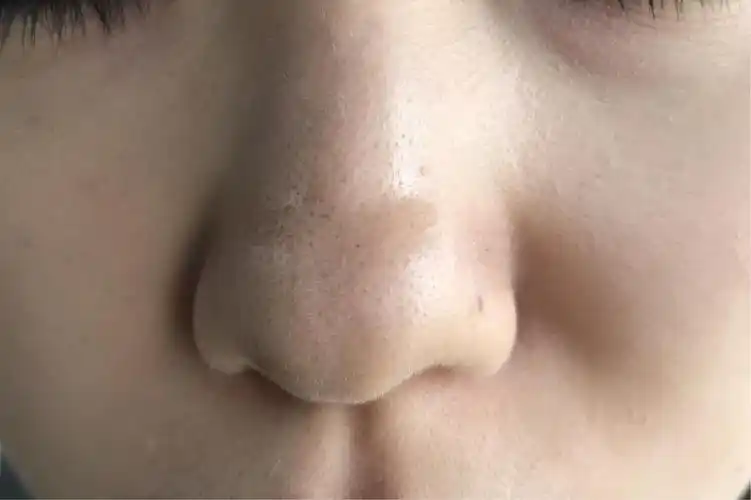 因为说白了,黑头其实就是氧化的油脂