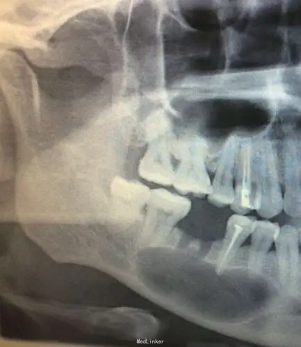 右下颌骨角化囊性瘤
