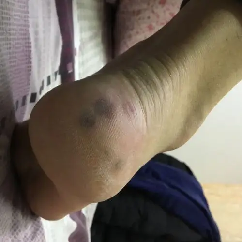 脚后跟冻疮怎么办