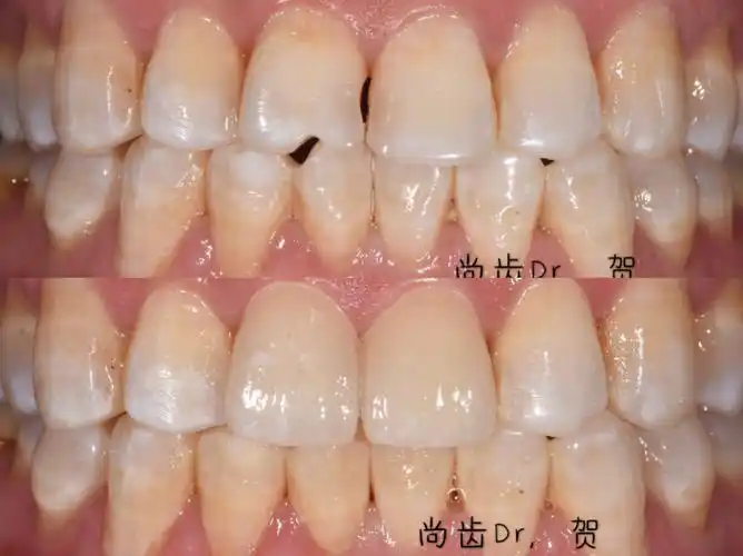 前牙瓷贴面修复