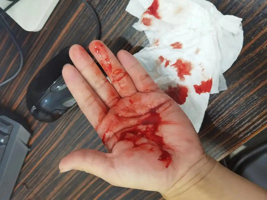 今天心情特别不好,干活不小心把手弄破了,流了好多血,伤在手上 - 抖音