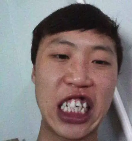 四:嘴若吹火牙漏风 嘴若吹火是俗称的吹火嘴,大多数看上去嘴巴是