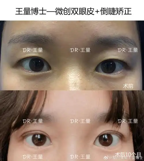 王量科普课堂##王量案例合集##倒睫矫正##微创双眼皮##双眼皮超话