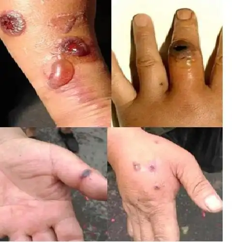 北京市报告1例外地来京就诊肺炭疽病例炭疽知识简答