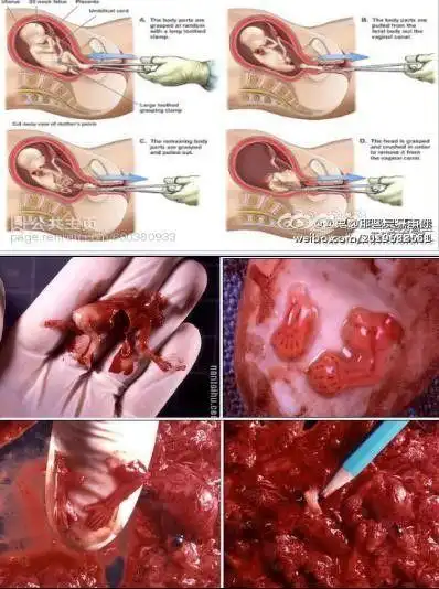 这就是堕胎之后!男人们,女人们,注意啦,不要因为一时享受而忽略生命!!