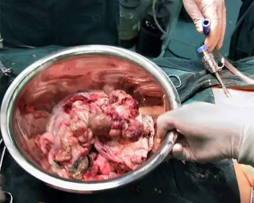 子宫囊肿什么时候手术最好 宫颈囊肿什么时候做手术最好- 育儿指南