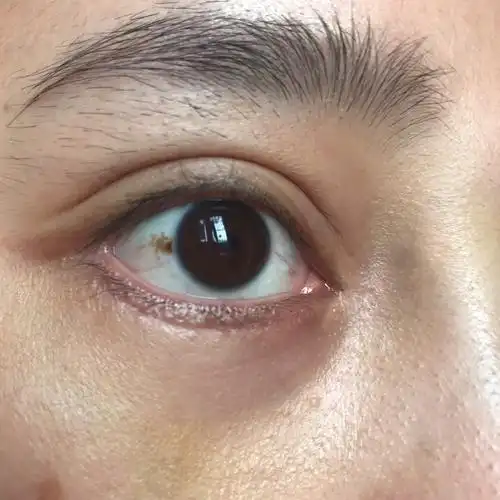 好烦做的眼袋内吸加下至外切!好当心会留疤痕!