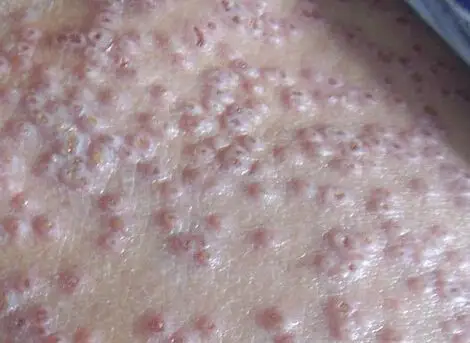 小儿过敏性皮炎症状