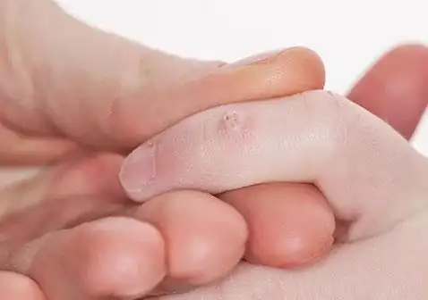 寻常疣手指上的寻常疣.寻常疣是凸起的,表面粗糙,有鹅卵石纹理.