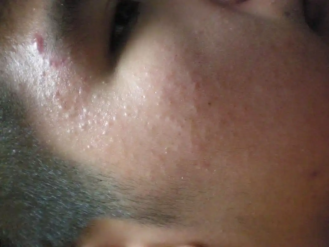 青少年油性皮肤起痘问题,求解答,,,,(附图)