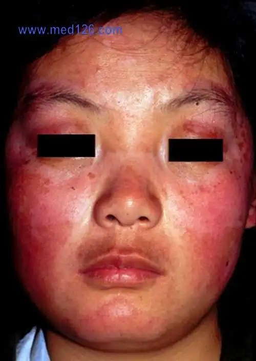 系统性红斑狼疮的临床表现