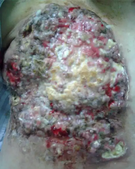 局部晚期乳腺癌病例分享一例(图片很震撼,胆小者勿看)