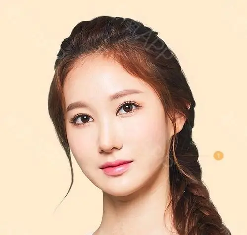 玻尿酸填充苹果肌