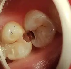 警惕邻面龋吃东西会塞牙牙还会从两边烂